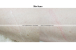 (13) skin scars